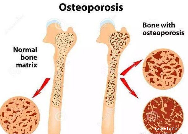 必威app精装版下载官网安装苹果告诉大家如何增加骨密度