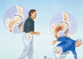 便携式骨密度检测仪骨质疏松患者应做哪些检查 便携式骨密度检测仪骨质疏松患者应做哪些检查