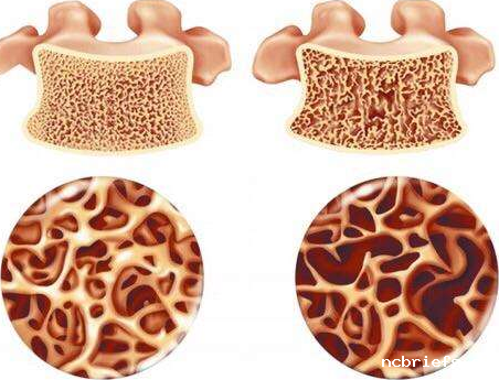 骨密度检测仪厂家分析造成骨密度低的原因 骨密度检测仪厂家分析造成骨密度低的原因