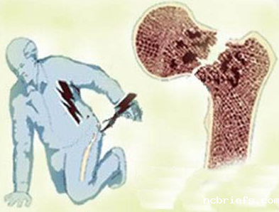 便携式骨密度检测仪分析老年人骨折后的症状有哪些？