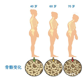 便携式骨密度检测仪厂家谈骨密度的数值越高越好吗