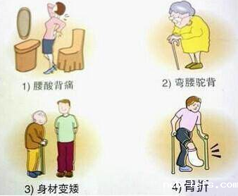 必威app精装版下载官网安装苹果厂家提醒用了激素要查骨密度 必威app精装版下载官网安装苹果厂家提醒用了激素要查骨密度