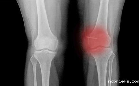 骨密度检测仪厂家分析骨密度低的症状 骨密度检测仪厂家分析骨密度低的症状