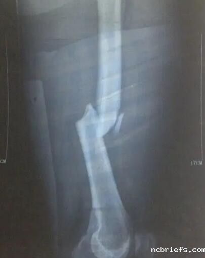 骨密度检测仪厂家提示骨折了要怎么办?就医和保养都需要及时 骨密度检测仪厂家提示骨折了要怎么办?就医和保养都需要及时