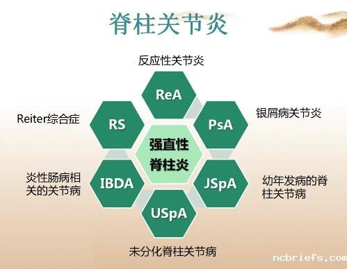 超声骨密度测定仪厂家提醒越歇息腰越痛当心得了“脊柱关节炎” 超声骨密度测定仪厂家提醒越歇息腰越痛当心得了“脊柱关节炎”