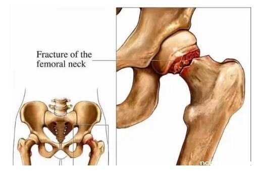 骨密度检测仪厂家提示为什么髋部骨折会称之为“人生道路最后一次骨折”? 骨密度检测仪厂家提示为什么髋部骨折会称之为“人生道路最后一次骨折”?