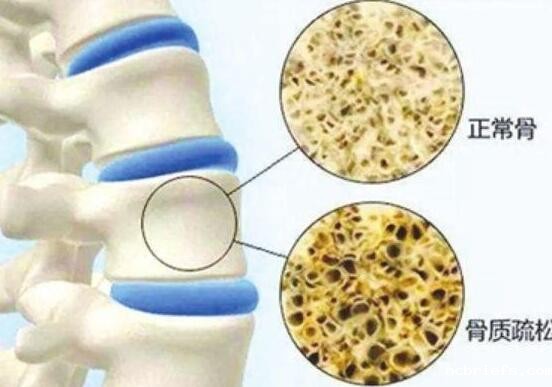 45岁后，便携式骨密度仪检测没到达规范的人，需求增强骨密度