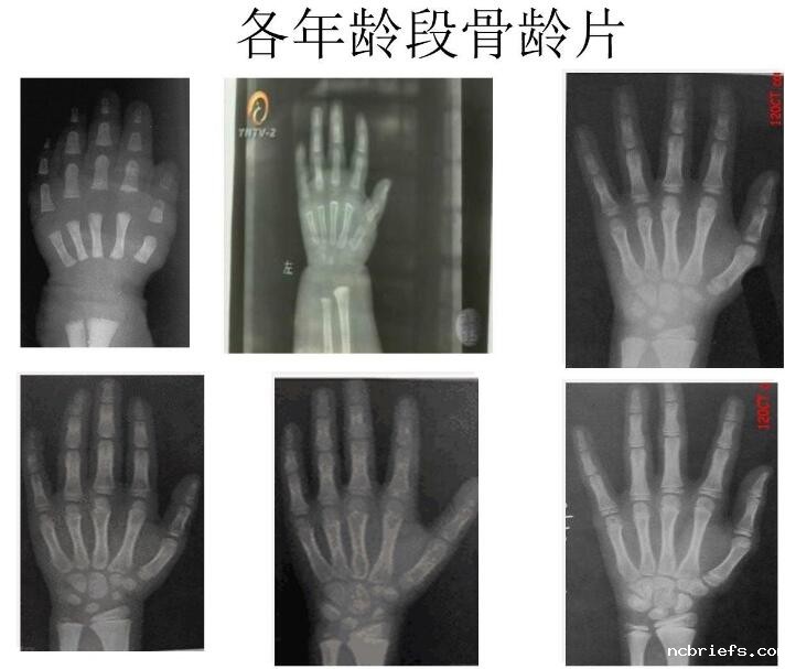 5月国康新推荐！儿童便携式骨密度检测仪品牌分析骨龄低的含义