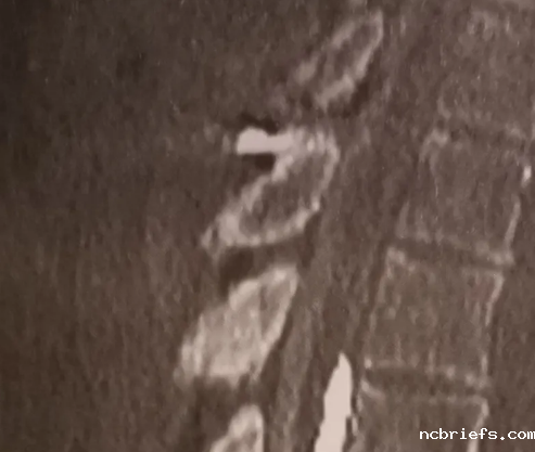 广东超声波骨密度测试仪生产厂家分析骨质疏松发病情况及面临的问题