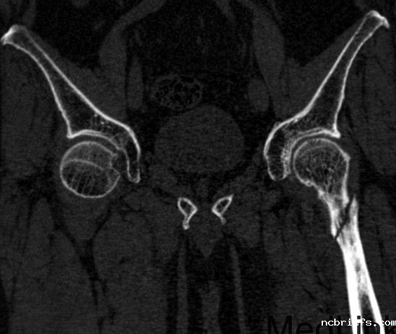 【gk-7000型号】便携式骨密度检测仪更方便检测左股骨粗隆间粉碎性骨折骨密度！
