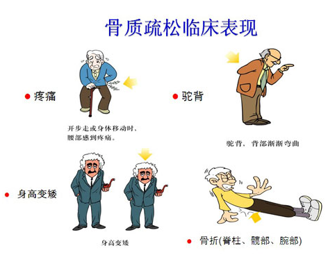 8.11便携式骨密度检测仪建议像“三高”一样应对骨质疏松症